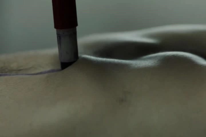 Inferior cava.�